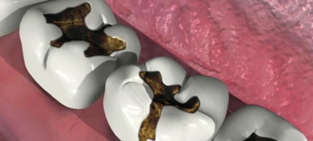 哪种植物能有效去除蛀牙蚜虫？