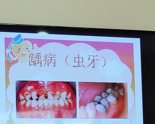哪种植物能有效去除蛀牙蚜虫？